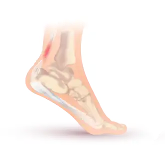 Description de l'image Achilles tendonitis.svg.