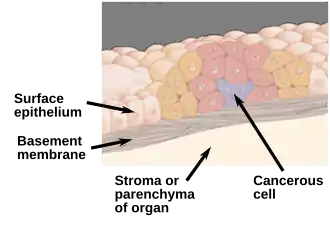 Description de l'image In situ carcinoma-en.svg.