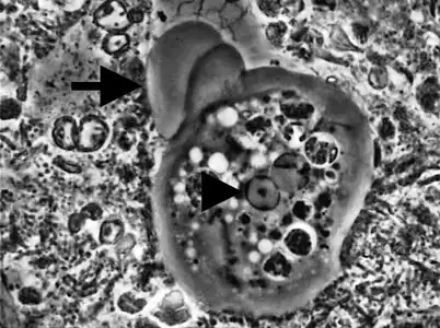 Entamoeba gingivalis un des parasites responsables de la parodontite.
